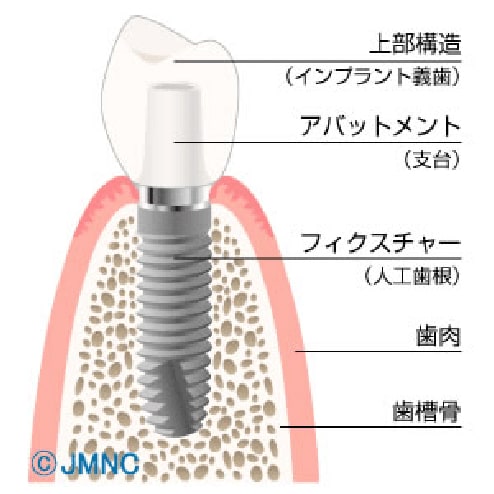インプラント施術の断面図